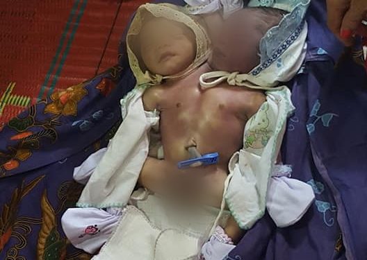 Bayi Kembar Siam Meninggal Dalam Perjalanan Ke Rumah Sakit Bayi Kembar Siam Meninggal Dalam Perjalanan Ke Rumah Sakit
