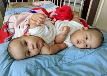Bayi Kembar Siam, Adam dan Malik Silitonga Butuh Perhatian