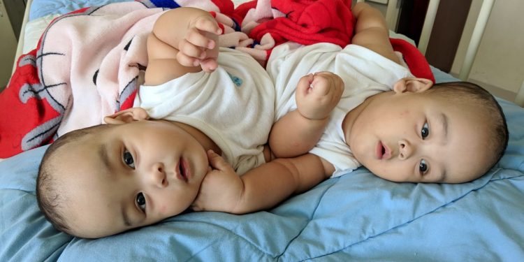 Bayi Kembar Siam, Adam dan Malik Silitonga Butuh Perhatian Bayi Kembar Siam, Adam dan Malik Silitonga Butuh Perhatian