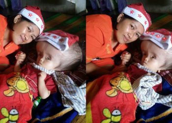 Begini Gabriel Alfaro Tampubolon, Balita Penderita Hidrocepalus Melewati Natal 