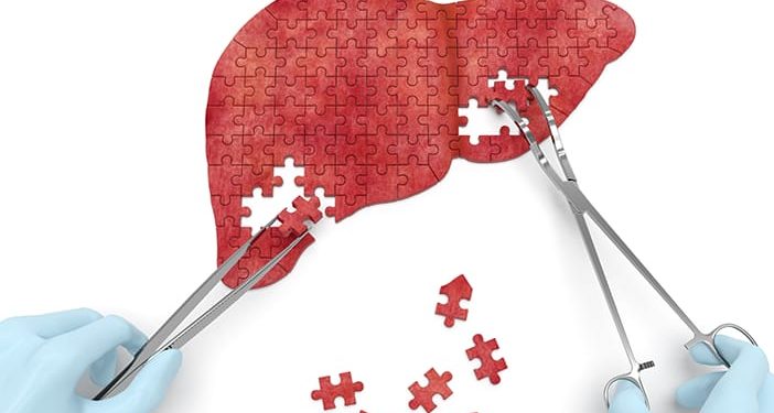 Kenali Penyebab Hepatitis dan Cara Mengatasinya Kenali Penyebab Hepatitis dan Cara Mengatasinya