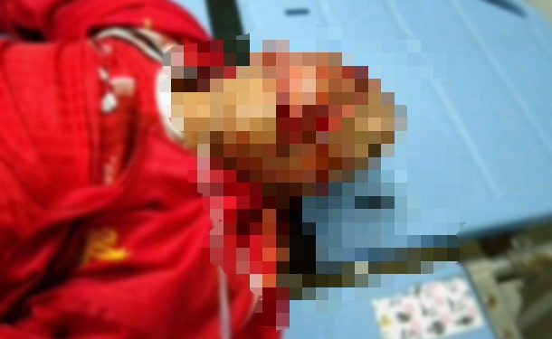 Diduga Mabuk Saat Berkendara, Amran Malau Tabrak Trotoar Hingga Tak Sadarkan Diri