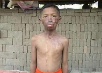 Wajah Samuel Kristian Disiram Ayah Tiri Pakai Air Keras