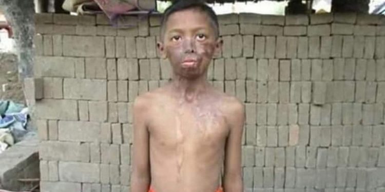 Wajah Samuel Kristian Disiram Ayah Tiri Pakai Air Keras