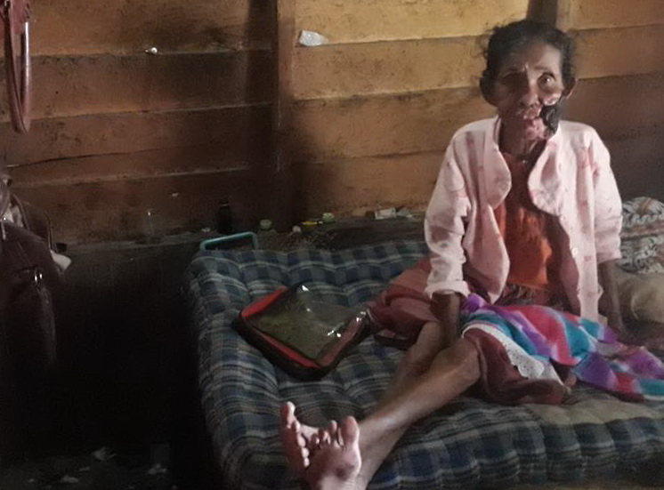 Menyedihkan, Tak Punya Biaya Berobat, Wajah Boru Pakpahan ini Perlahan Digerogoti Kanker. Ia berharap ikut merasakan indahnya Natal... Menyedihkan, Tak Punya Biaya Berobat, Wajah Boru Pakpahan ini Perlahan Digerogoti Kanker. Ia berharap ikut merasakan indahnya Natal...