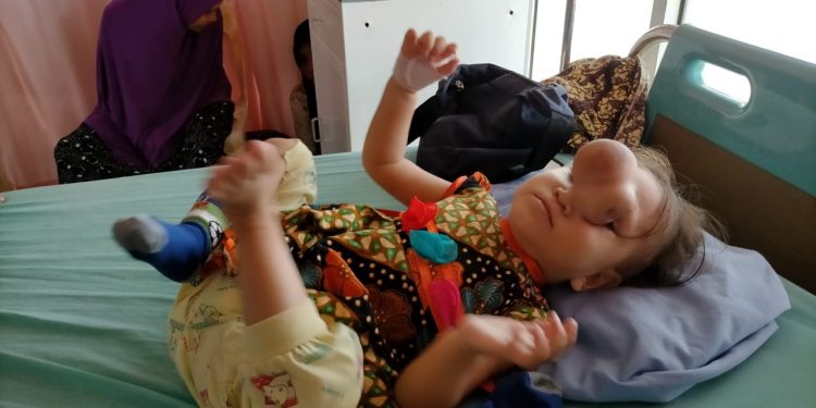 Nur Jannah Bocah Berusia Dua Tahun Mengidap Tumor di Wajah, Butuh Uluran Tangan