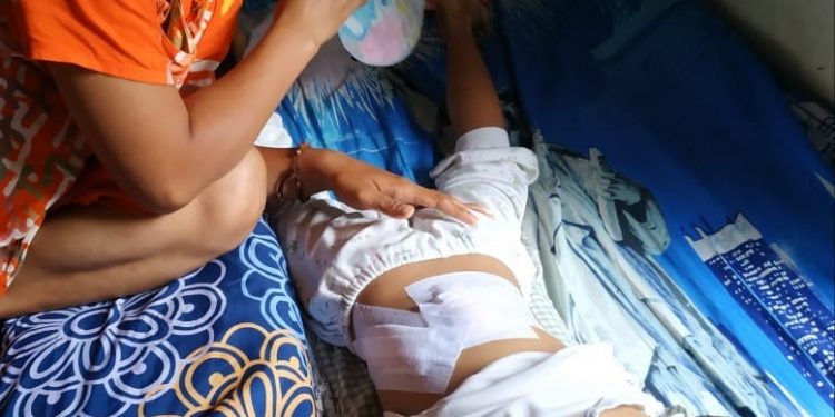 Bocah 5 Tahun Diserang 2 Ekor Monyet Liar, Hingga Harus Dapat 42 Jahitan