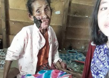 Menyedihkan, Tak Punya Biaya Berobat, Wajah Boru Pakpahan ini Perlahan Digerogoti Kanker. Ia berharap ikut merasakan indahnya Natal...