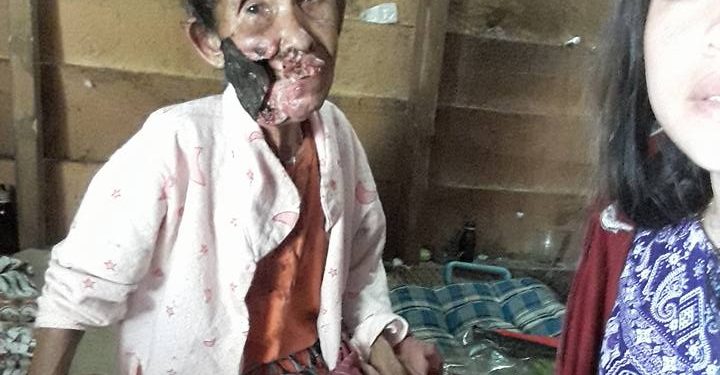 Menyedihkan, Tak Punya Biaya Berobat, Wajah Boru Pakpahan ini Perlahan Digerogoti Kanker. Ia berharap ikut merasakan indahnya Natal... Menyedihkan, Tak Punya Biaya Berobat, Wajah Boru Pakpahan ini Perlahan Digerogoti Kanker. Ia berharap ikut merasakan indahnya Natal...