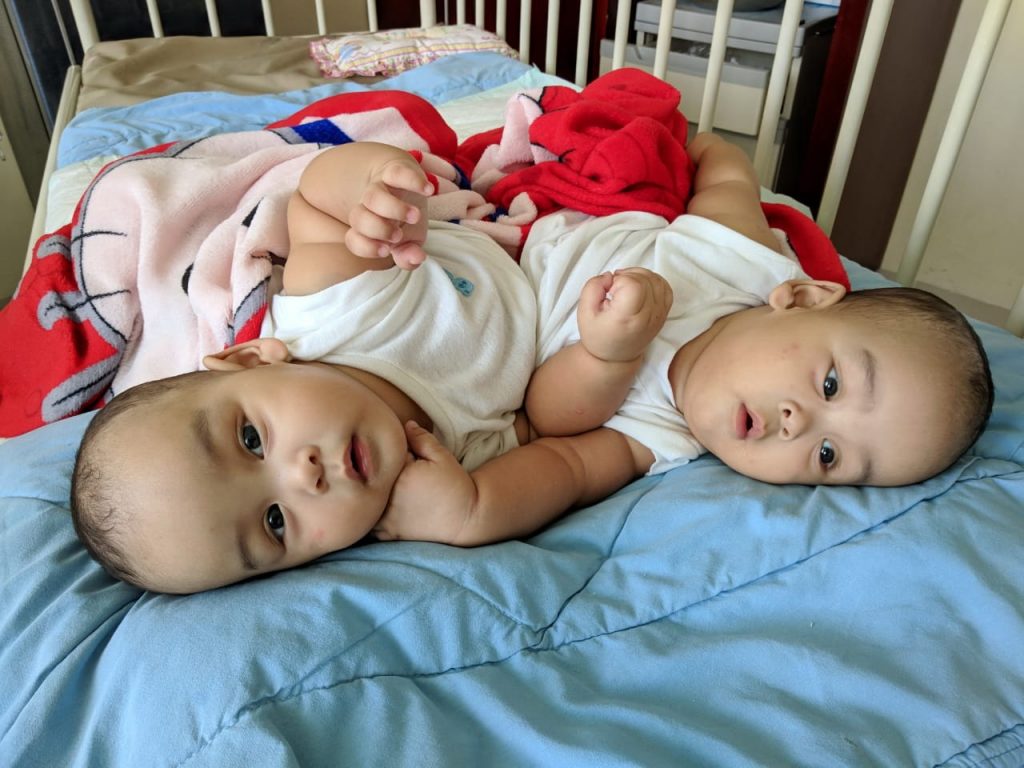 Bayi Kembar Siam Adam dan Malik Silitonga Asal Taput Membaik dan Pulang Pekan Depan Bayi Kembar Siam Adam dan Malik Silitonga Asal Taput Membaik dan Pulang Pekan Depan