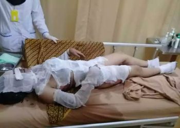 Sadis! Pacaran 6 Bulan, Gadis Ini Dibakar Kekasihnya