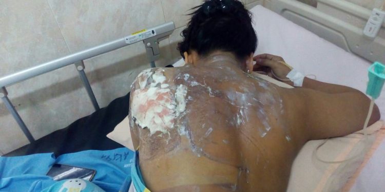 Boru Harahap Pelaku Penyiranman Kuah Lontong Panas Dijebloskan ke Penjara